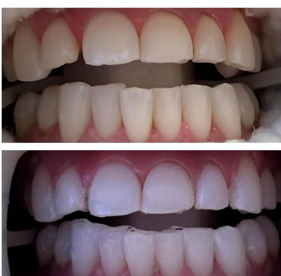 Teeth whitening before and after